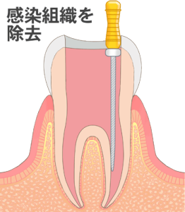 神経（歯髄）を除去した歯