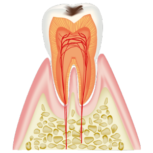 エナメル質がむし歯に侵された歯